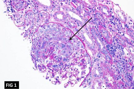 Anti-GBM (Anti-Glomerular Basement Membrane)