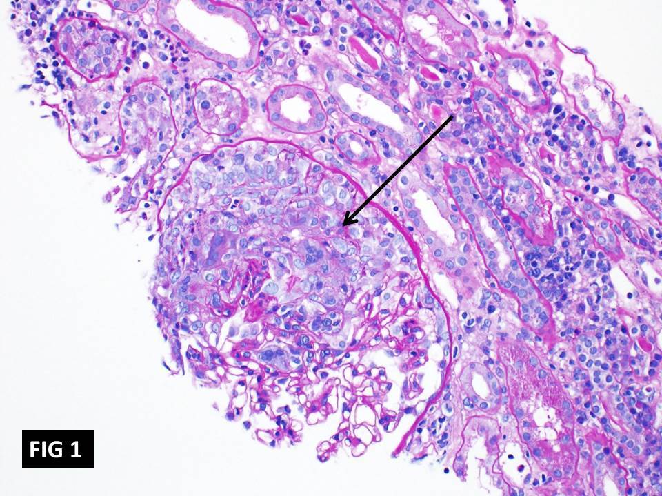 Anti-GBM (Anti-Glomerular Basement Membrane)