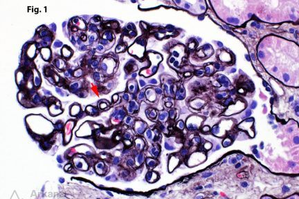 transplant glomerulopathy, Chronic Active Antibody-Mediated Rejection