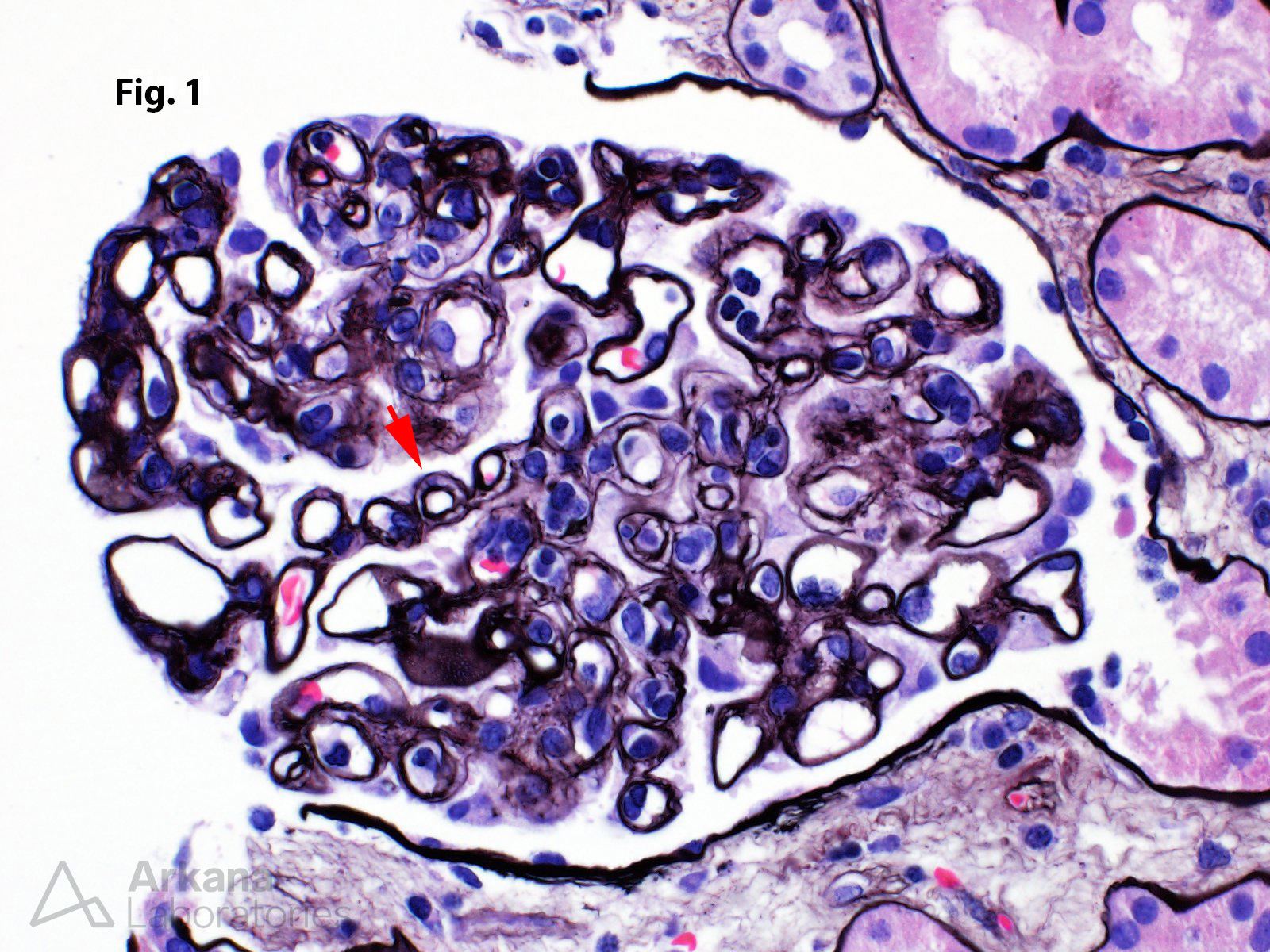 transplant glomerulopathy, Chronic Active Antibody-Mediated Rejection