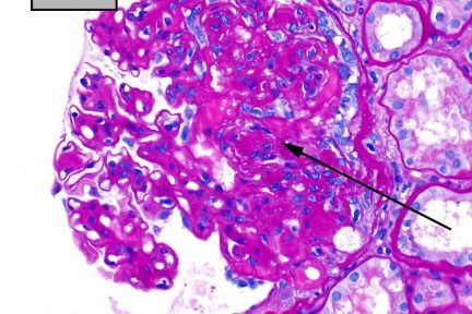 Focal segmental glomerulosclerosis (FSGS)