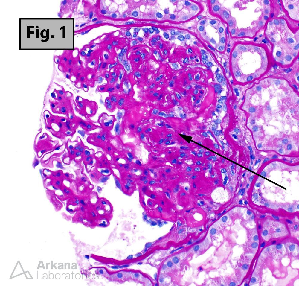 Focal segmental glomerulosclerosis (FSGS)