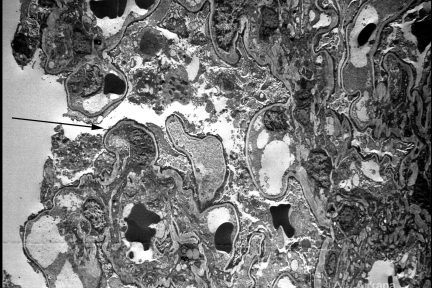 Focal Segmental Glomerulosclerosis