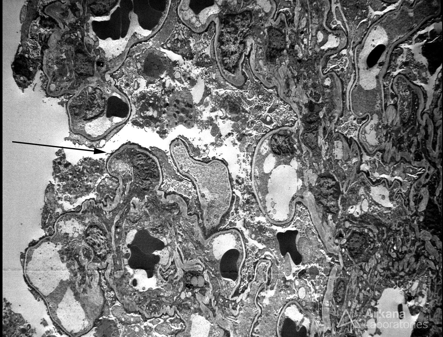 Focal Segmental Glomerulosclerosis