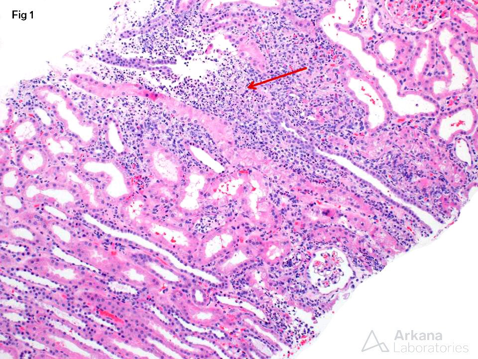 Fungus Microabscess, acute kidney disease