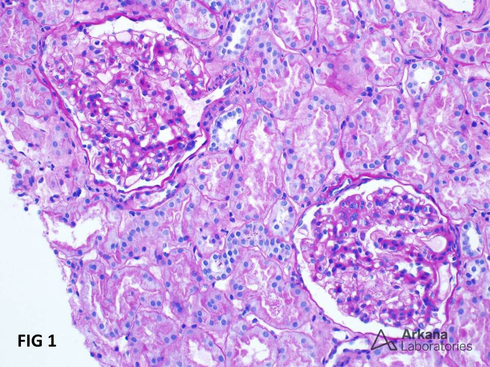 IgA Nephropathy