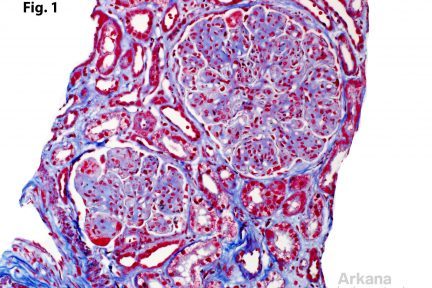 Immunotactoid Glomerulopathy, glomerular changes seen with Masson trichrome staining, including capillary wall thickening, capillary proliferation, mesangial matrix expansion, glomerular tuft lobulation, and fuchsinophilic capillary wall deposits