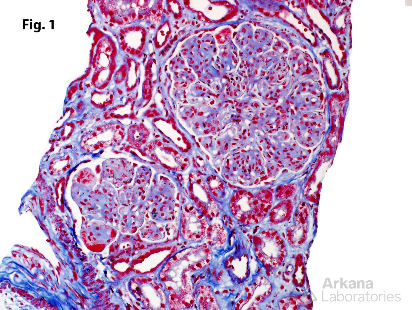 Immunotactoid Glomerulopathy, glomerular changes seen with Masson trichrome staining, including capillary wall thickening, capillary proliferation, mesangial matrix expansion, glomerular tuft lobulation, and fuchsinophilic capillary wall deposits