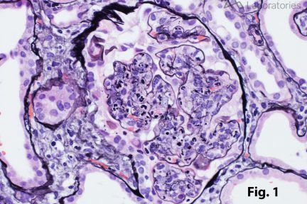 Infection-Associated Glomerulonephritis in renal biopsy