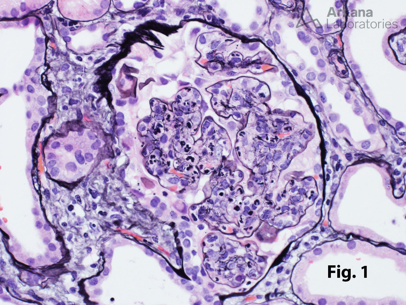 Infection-Associated Glomerulonephritis in renal biopsy