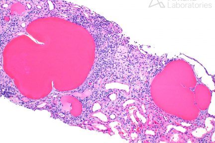 Microcystic Tubular Dilatation