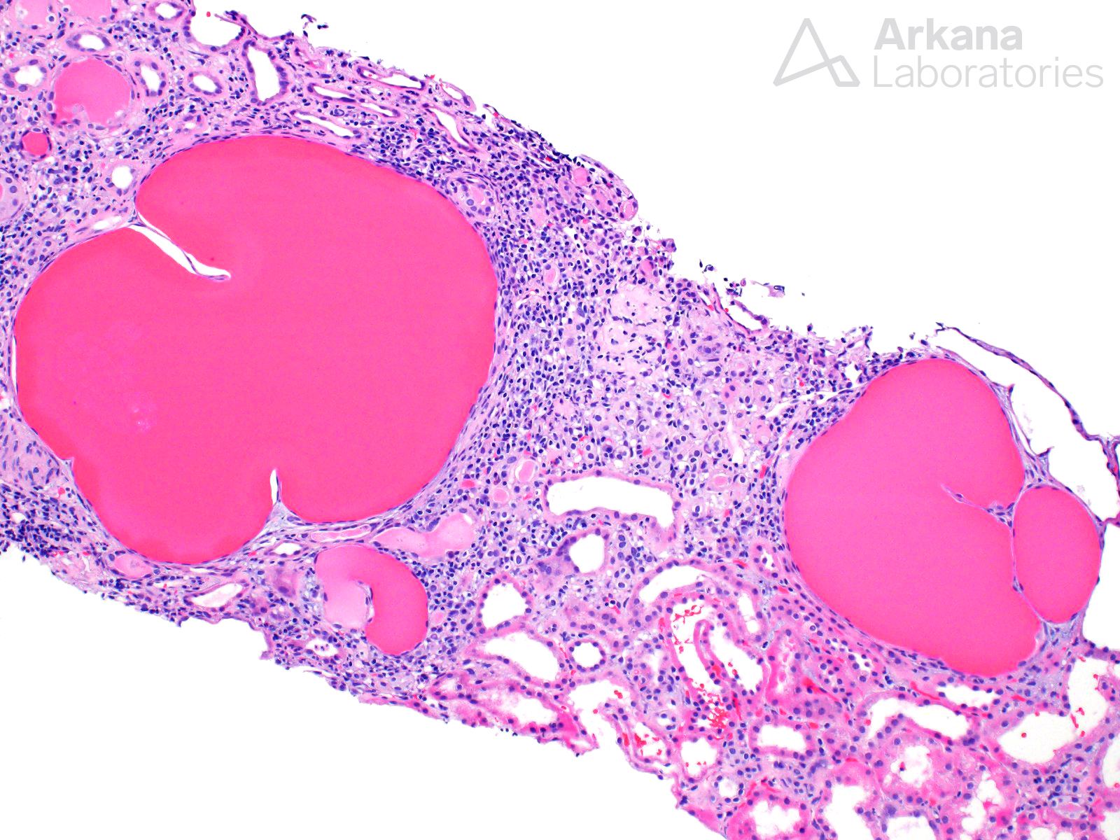 Microcystic Tubular Dilatation