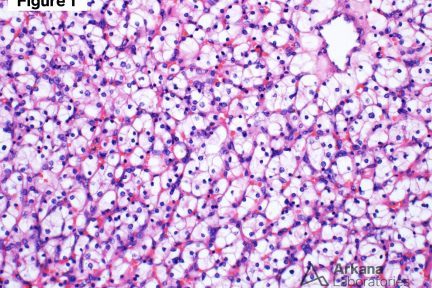 Renal Cell Carcinoma