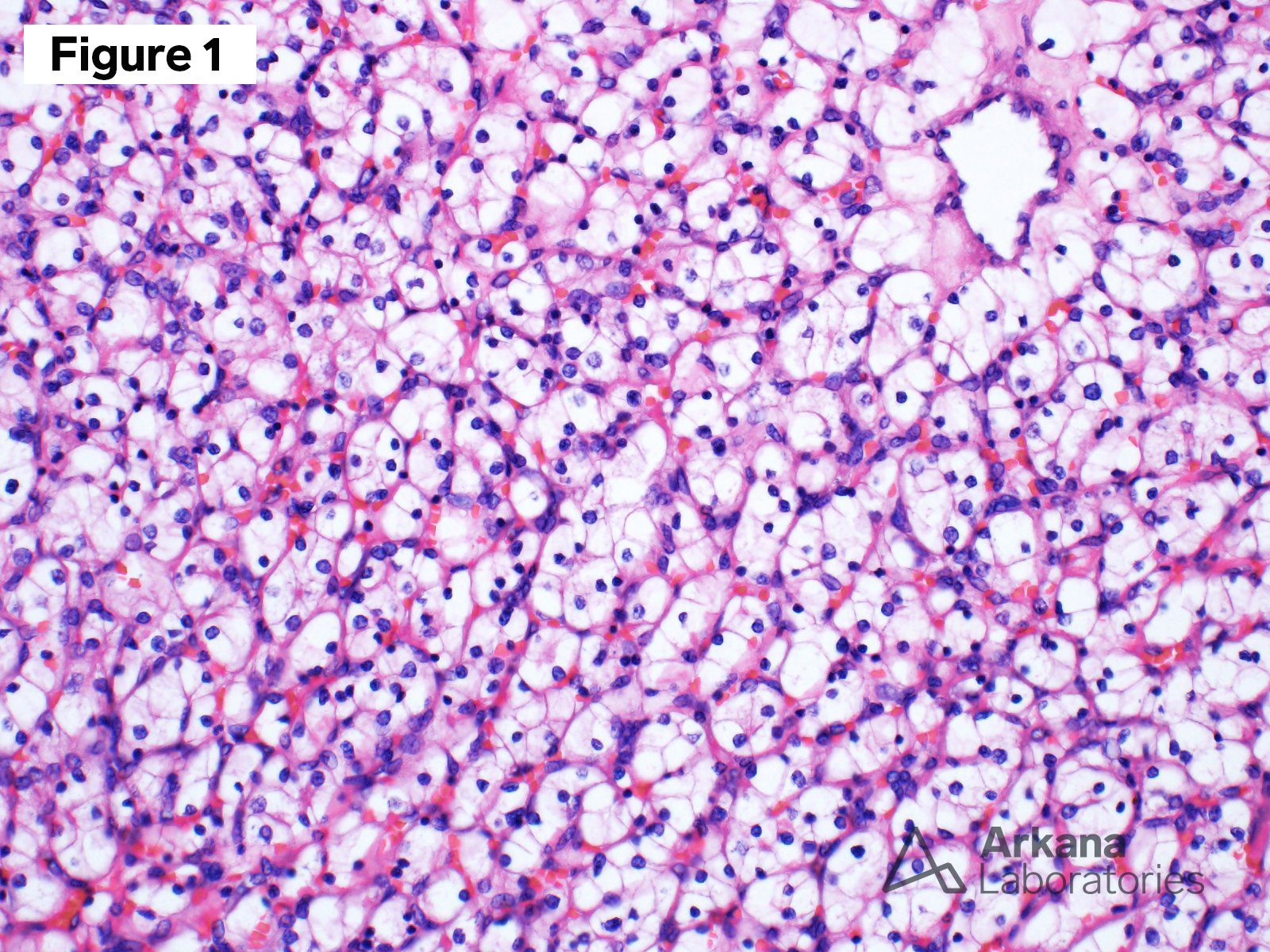 Renal Cell Carcinoma