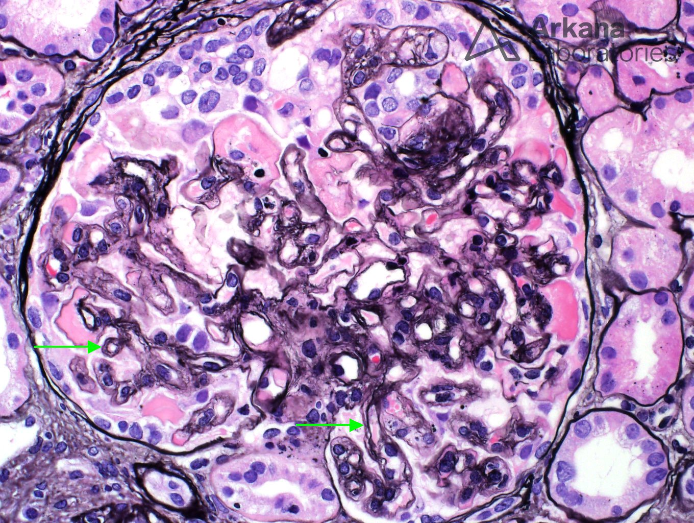 Anti-VEGF Effect