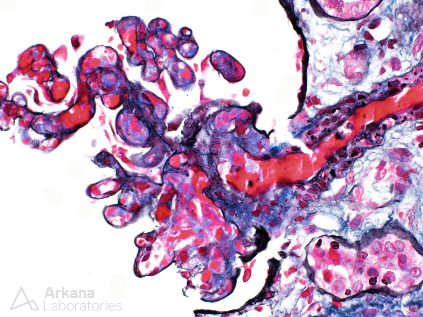 Antiphospholipid Antibody Syndrome