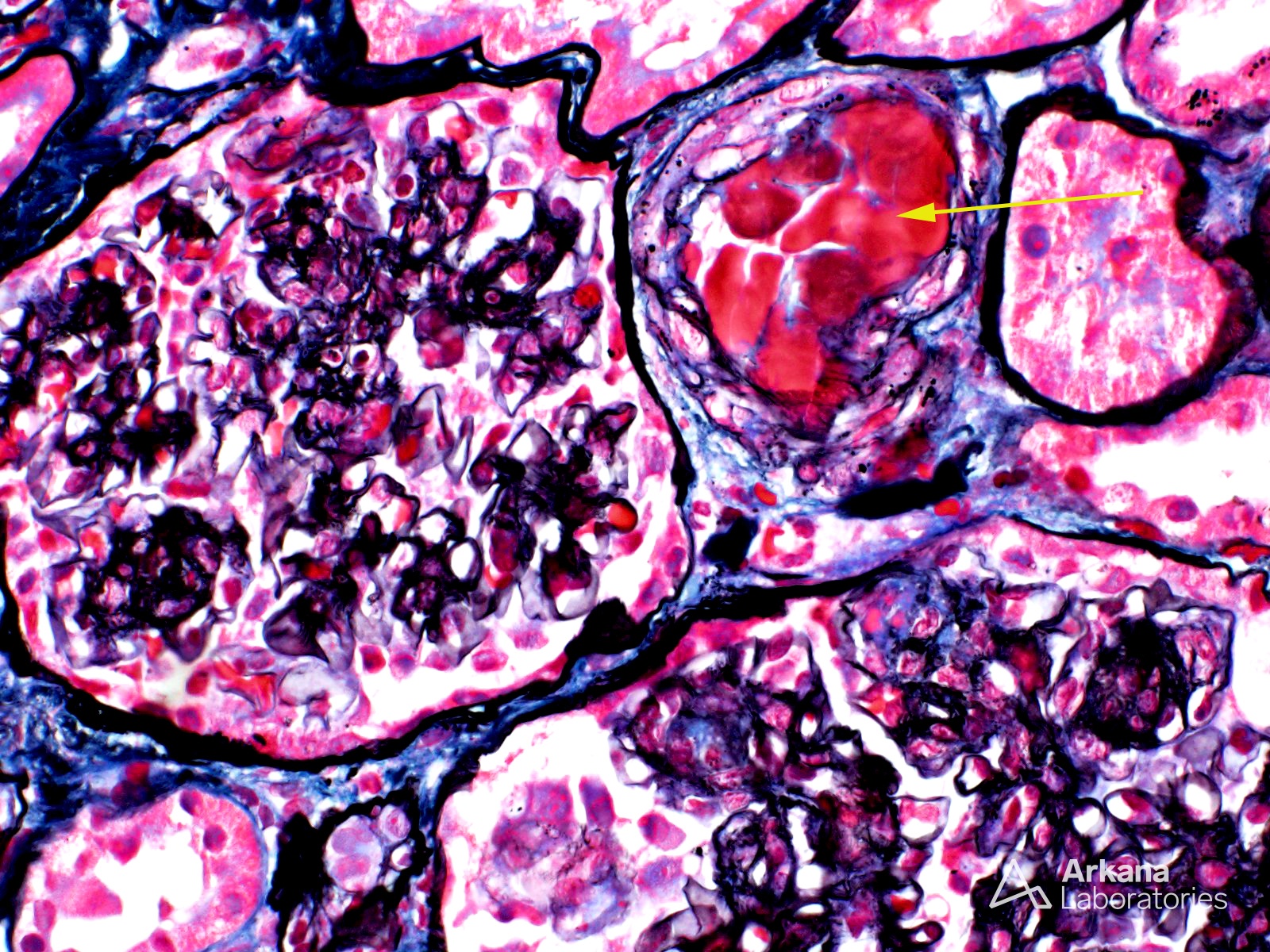 bevel diepvries Machtigen Waldenstrom Macroglobulinemia | Teaching Points | Arkana Laboratories