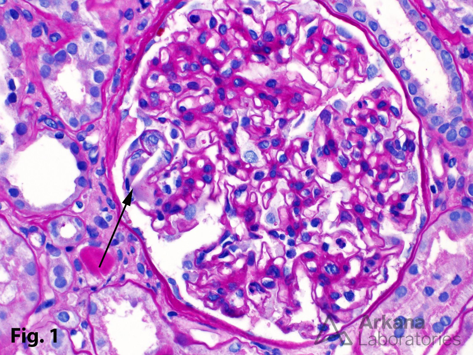 Cholesterol Microemboli