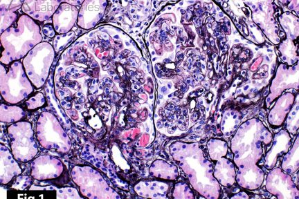 Cryoglobulinemic Deposits