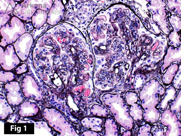 Cryoglobulinemic Deposits by EM Teaching Points Arkana Laboratories