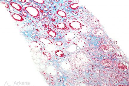 Papillary Necrosis