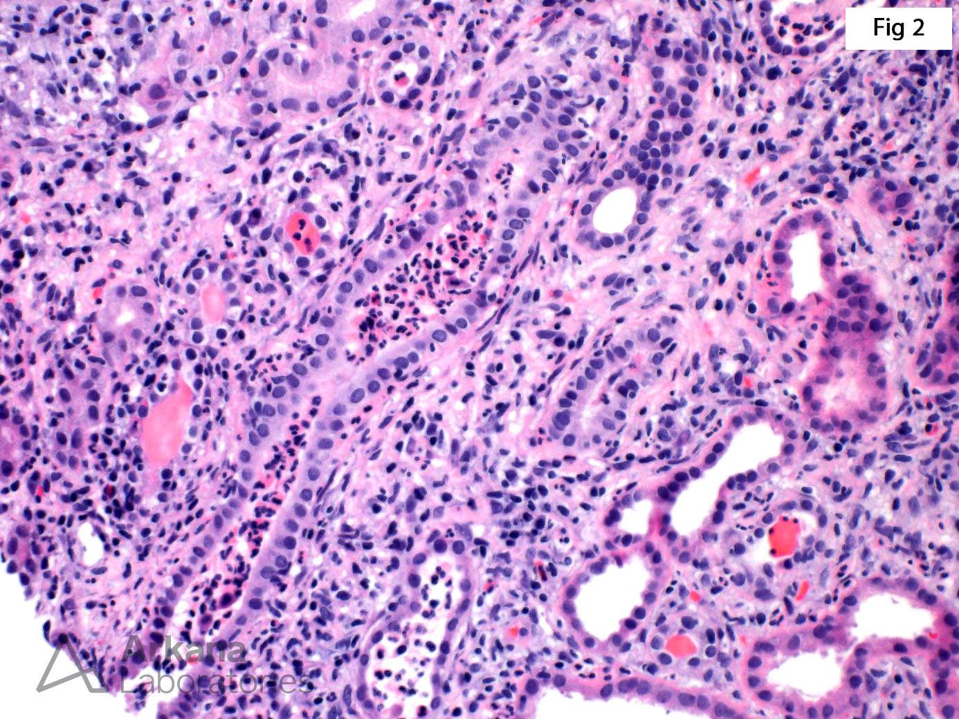 Chronic Active Tubulointerstitial Nephritis