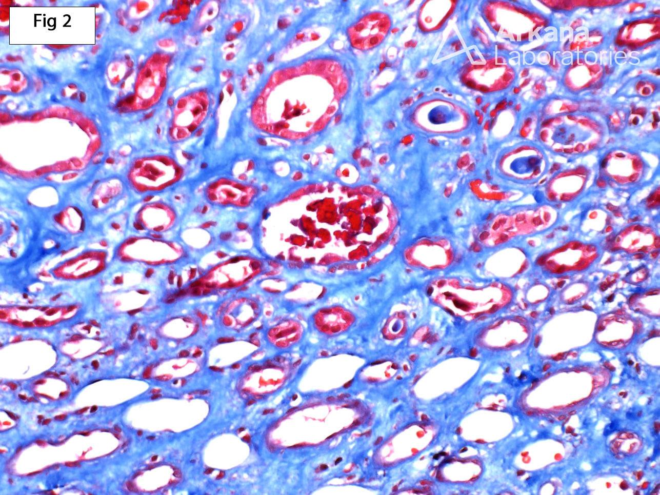 Acute Tubular Injury With Pigmented Casts