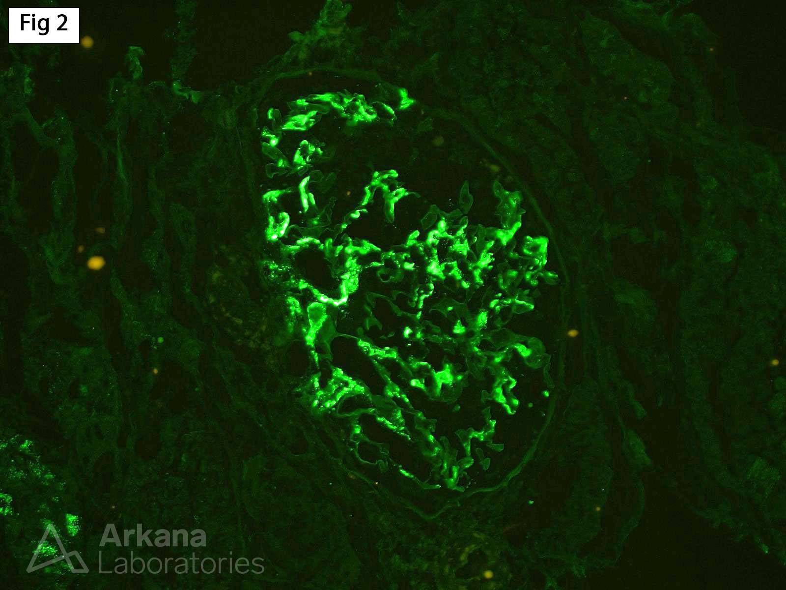 mesangial immune deposits which stain positive for IgA kappa and lambda