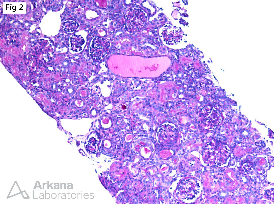 focal microcystic tubular dilatation and mild interstitial fibrosis, Congenital Nephrotic Syndrome