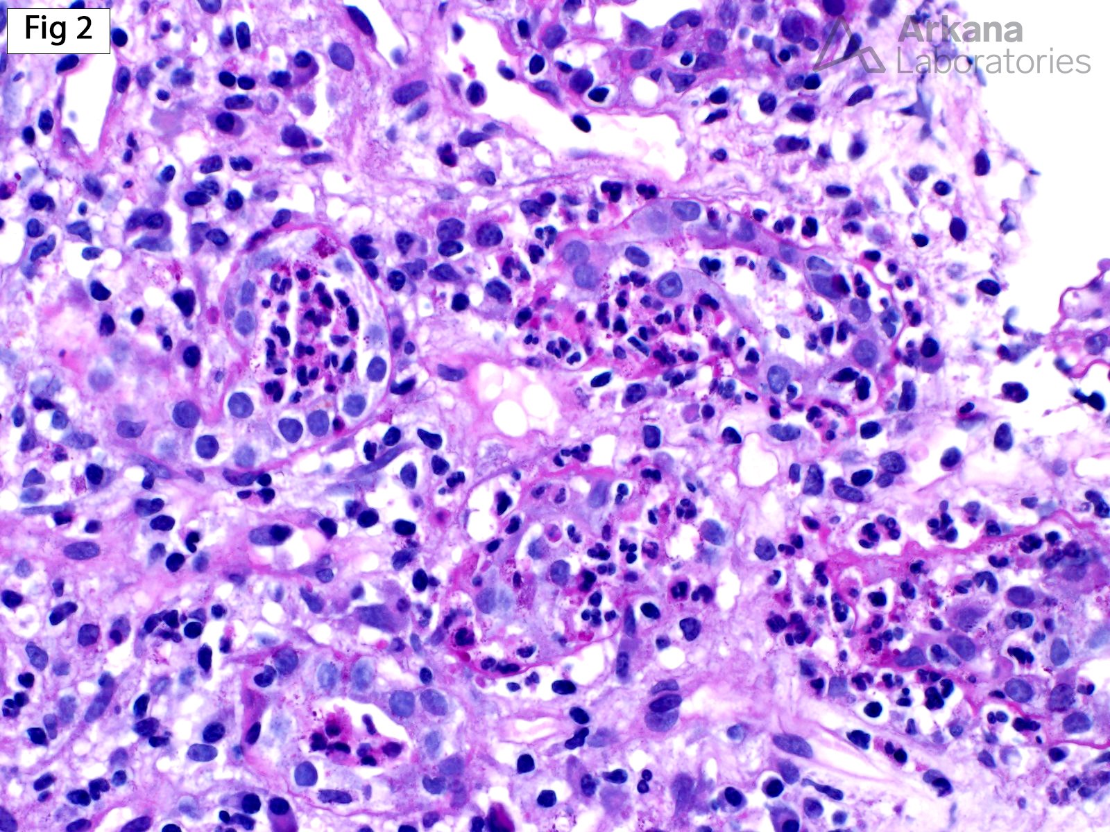 Acute Pyelonephritis