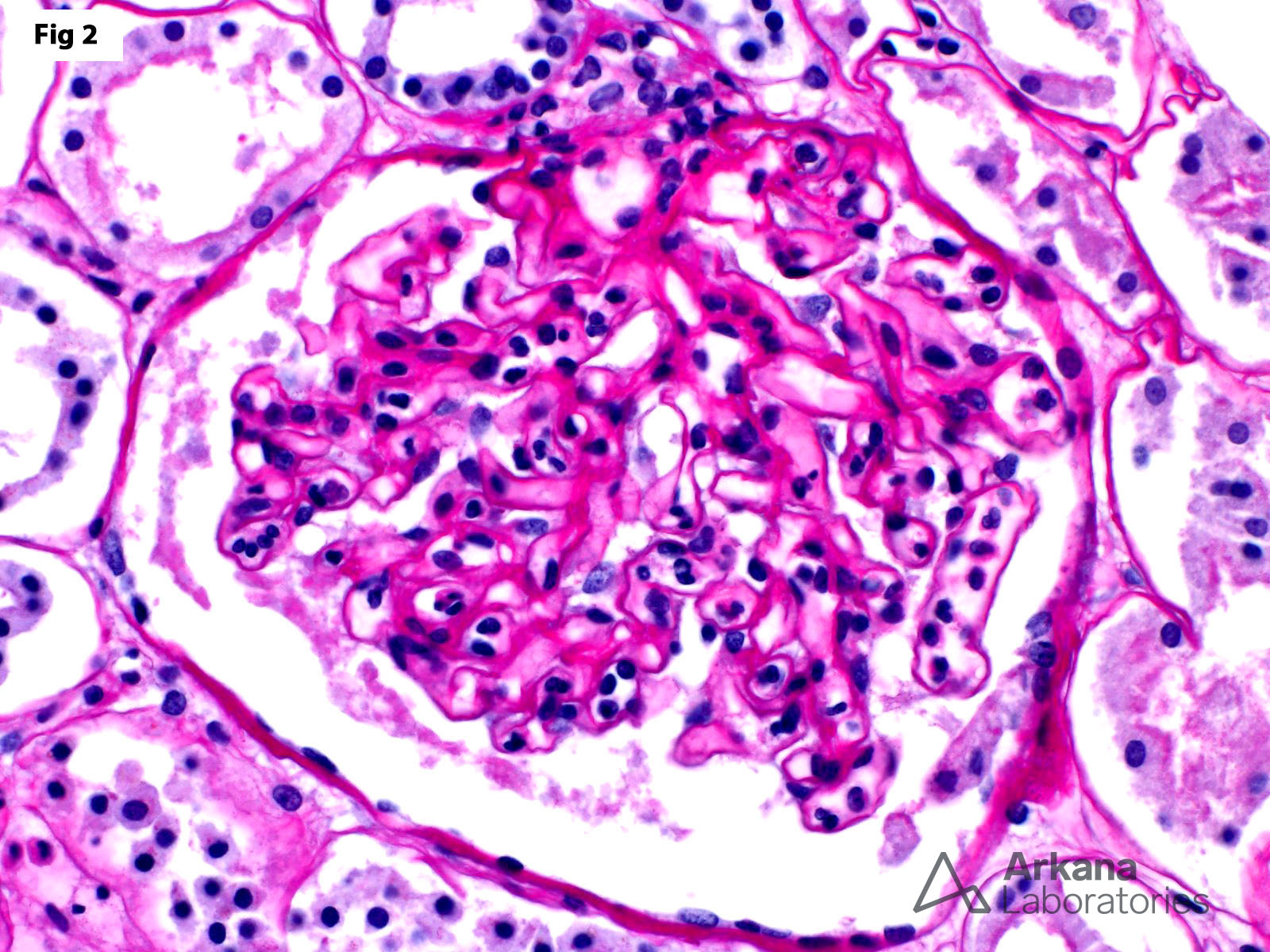 margination of neutrophils, renal vein thrombosis