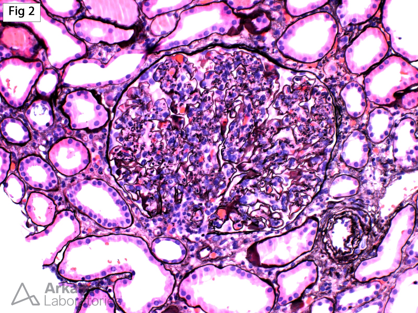 Glomerulonephritis