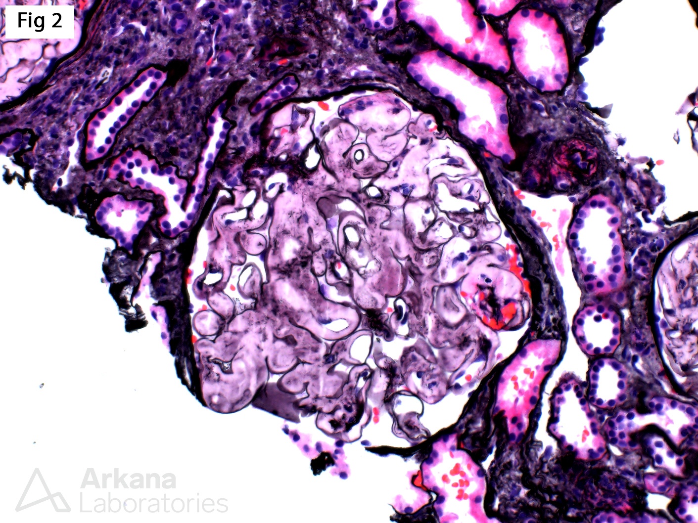 Fibrinogen Aα-chain Amyloidosis