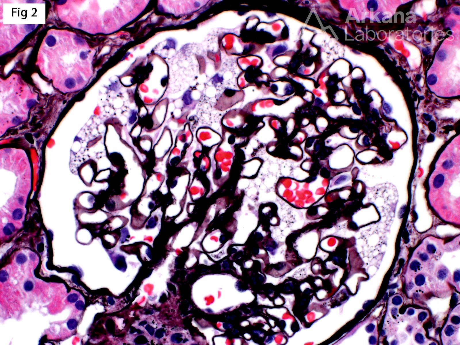 Fabry Disease