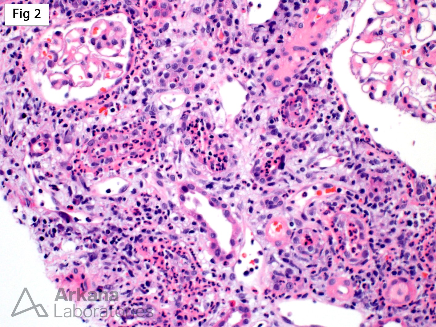 Acute Pyelonephritis, severe neutrophilic inflammation associated with remarkable rimming of the tubules, neutrophilic tubulitis and neutrophilic casts