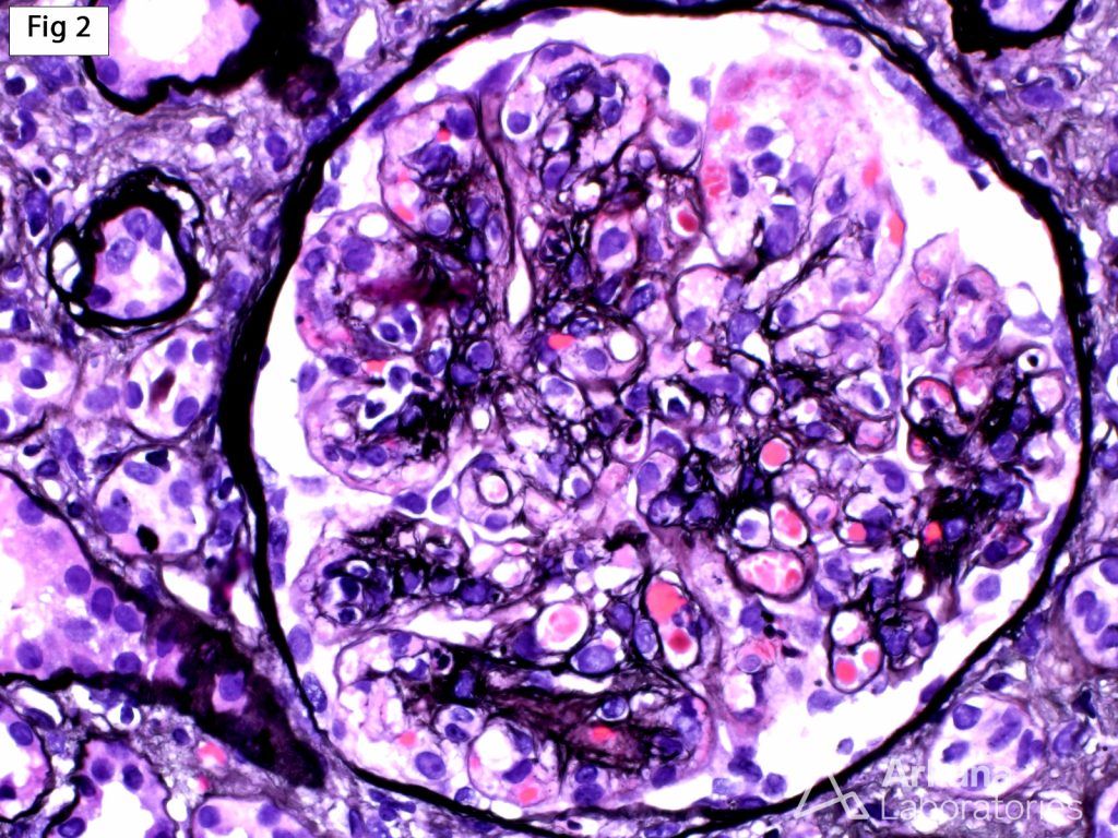 Hep C-Associated Cryoglobulinemic Glomerulonephritis | Arkana
