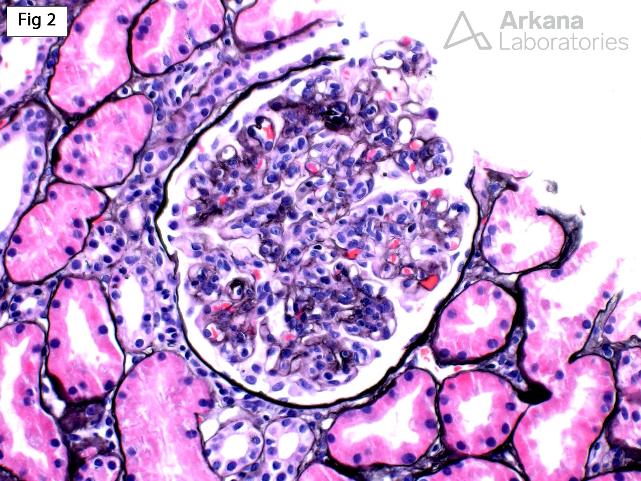 Proliferative Glomerulonephritis with Monoclonal IgG Deposits