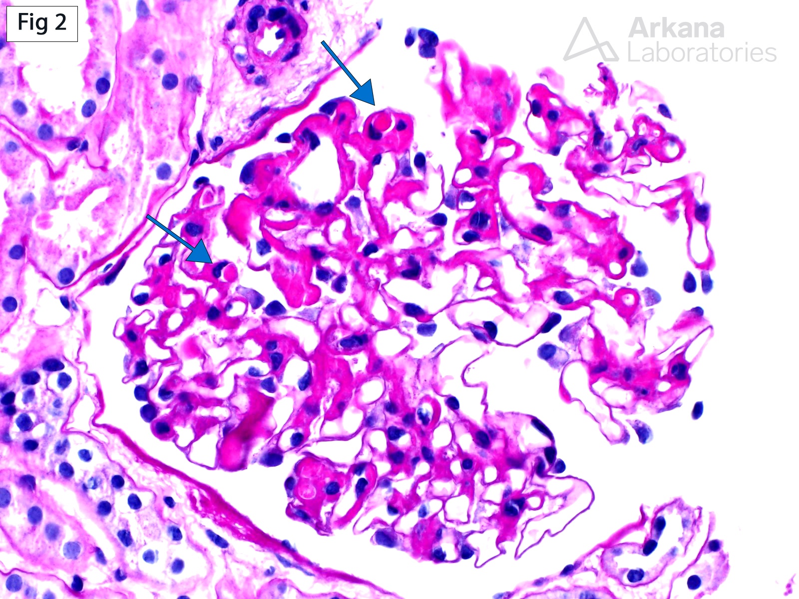 Immune Deposits in SLE