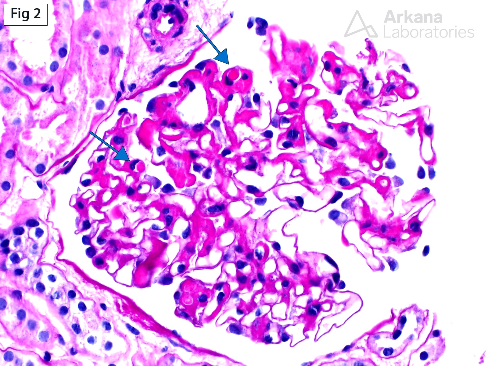 necrotizing lesions, glomeruli, large subendothelial immune deposits