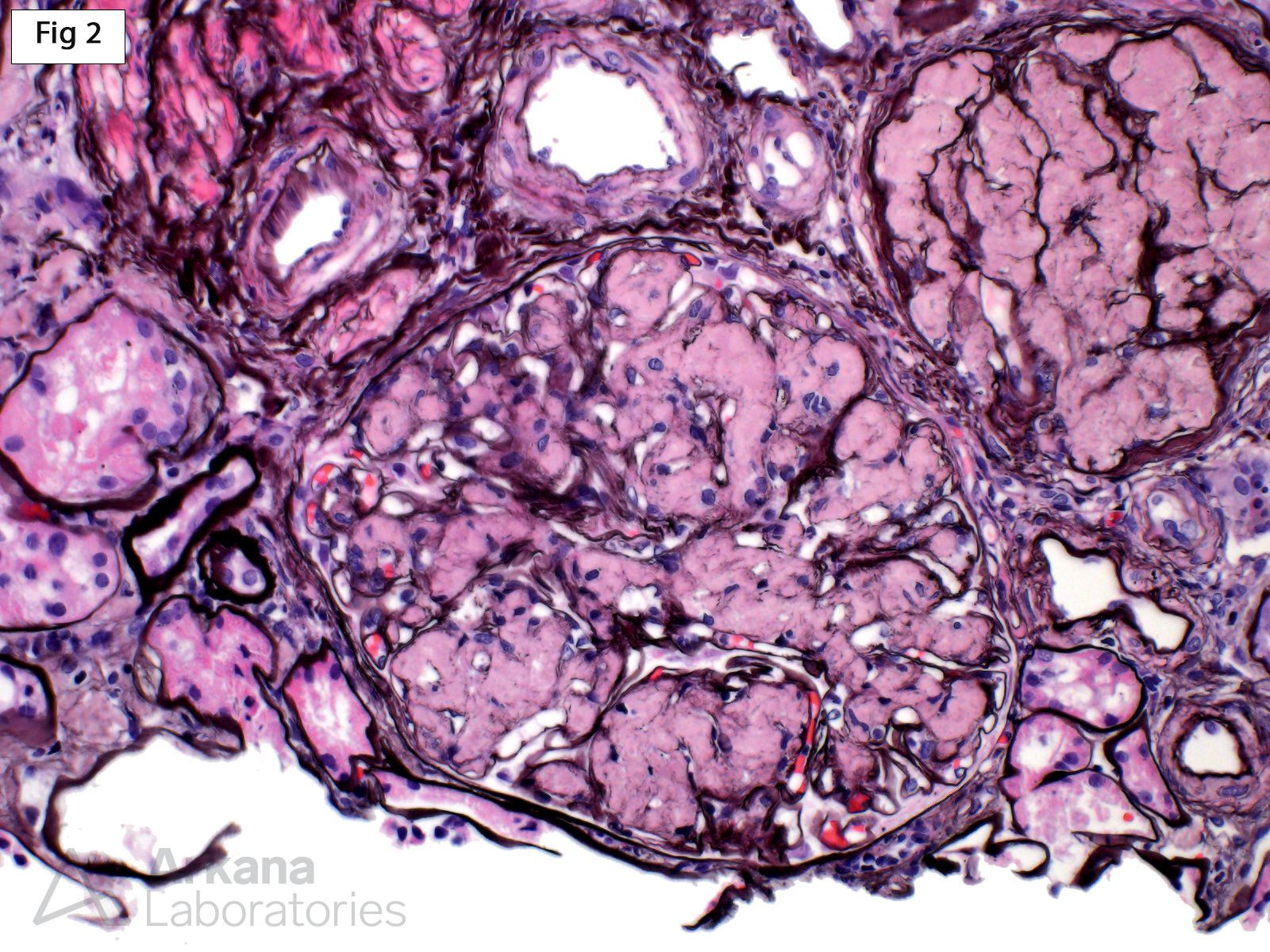 LECT2 Amyloidosis