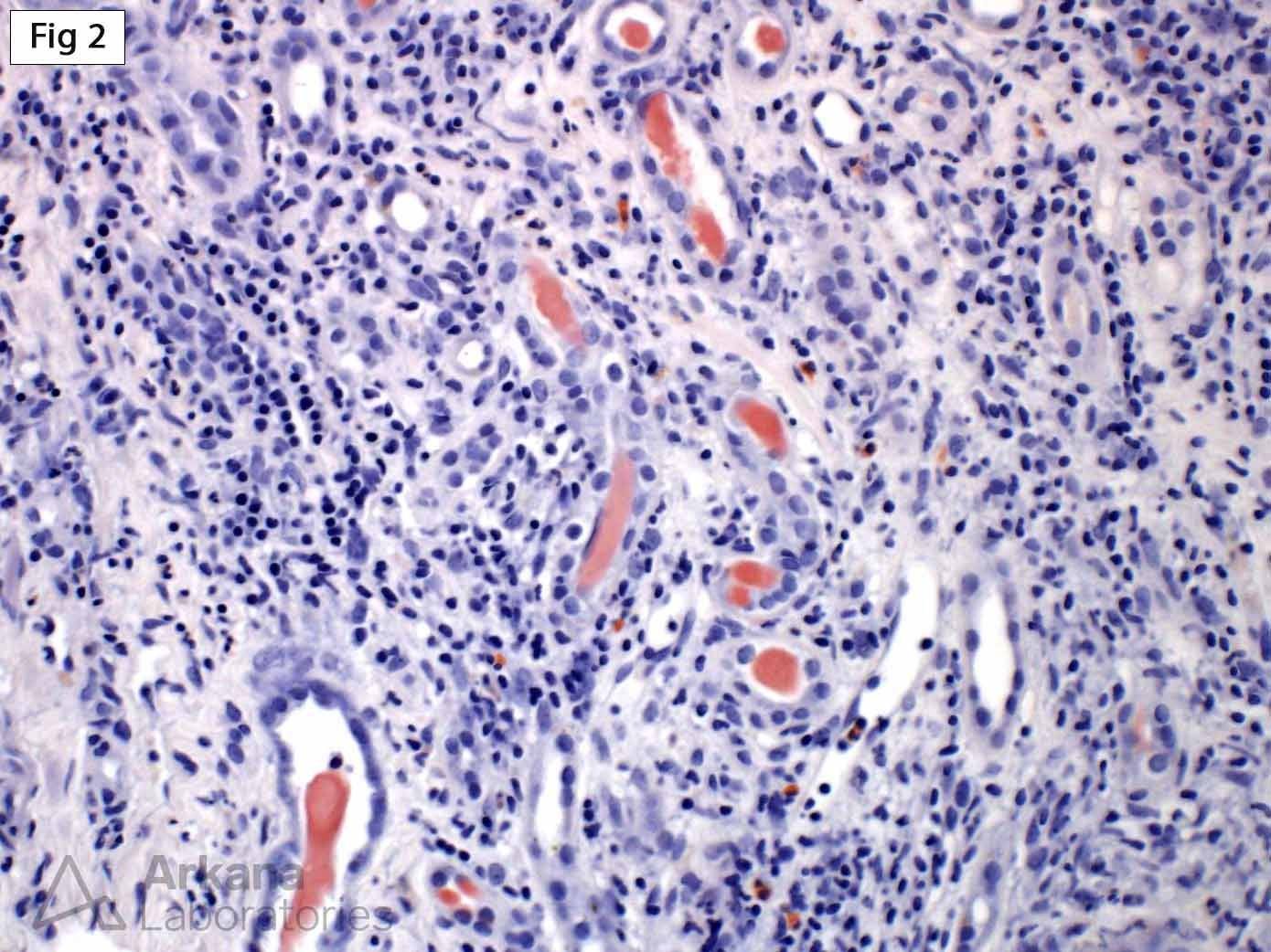 Light Chain Cast Nephropathy with Congo Red Staining
