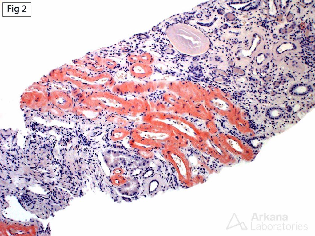 amyloid deposits, AL Amyloidosis