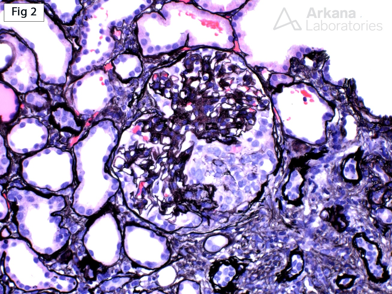 Crescentic Fibrillary Glomerulopathy