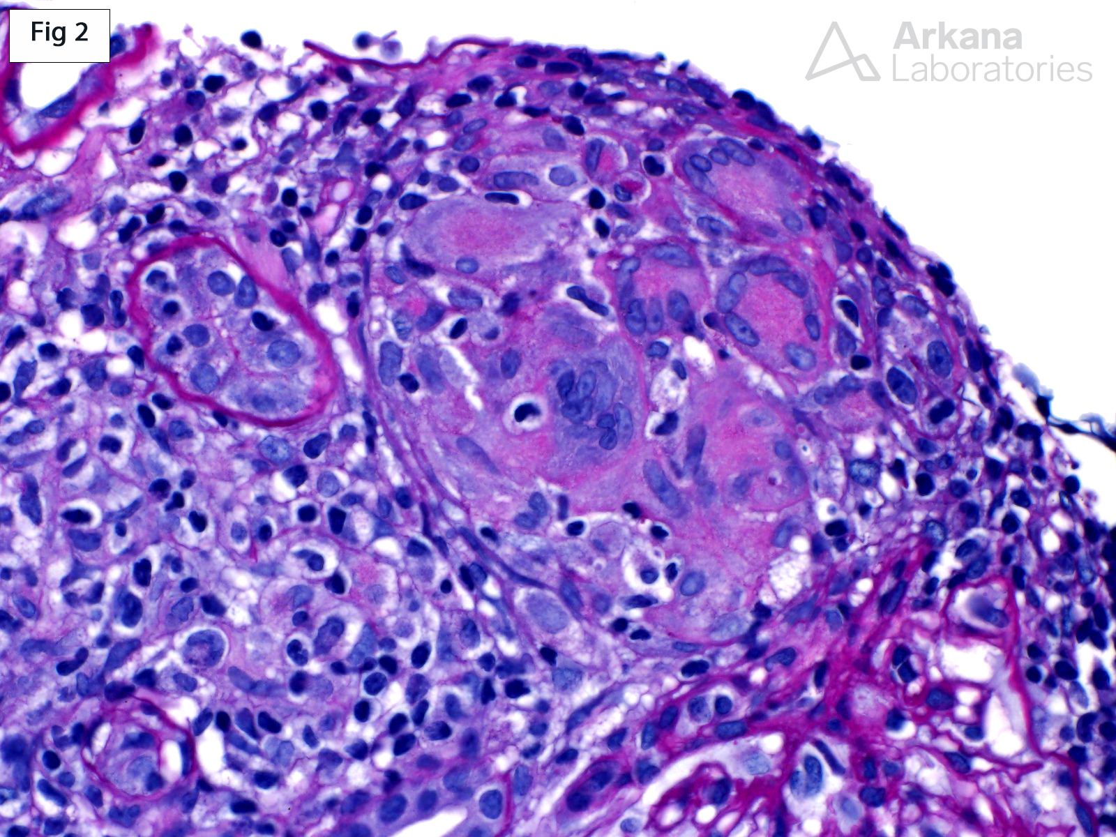 Granulomatous Interstitial Nephritis in CLL