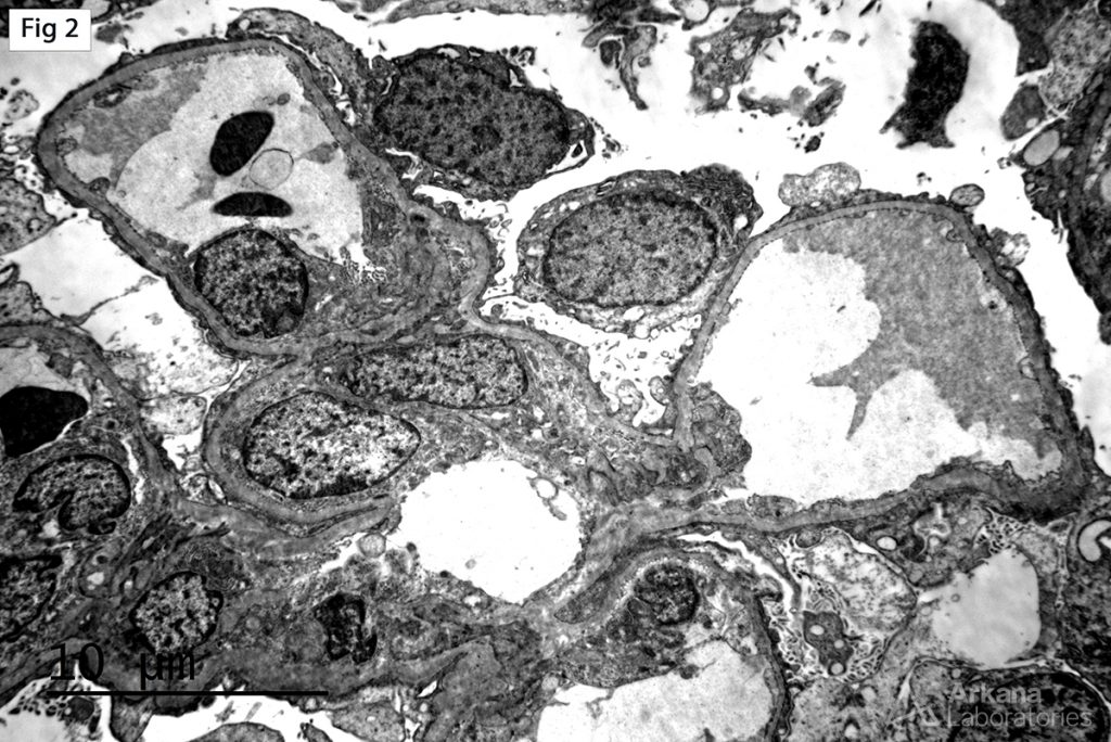 Focal Segmental Glomerulosclerosis (FSGS), widespread blunting, widening and effacement of epithelial foot processes