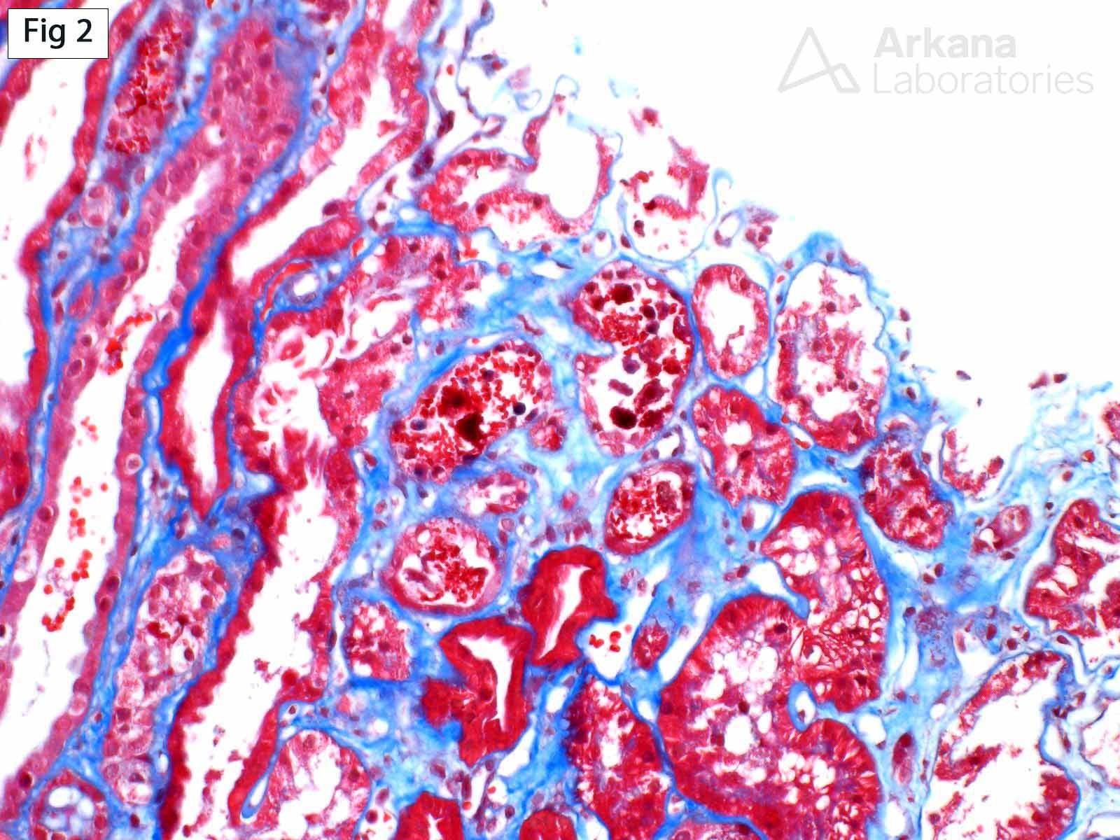 Intravascular Hemolysis