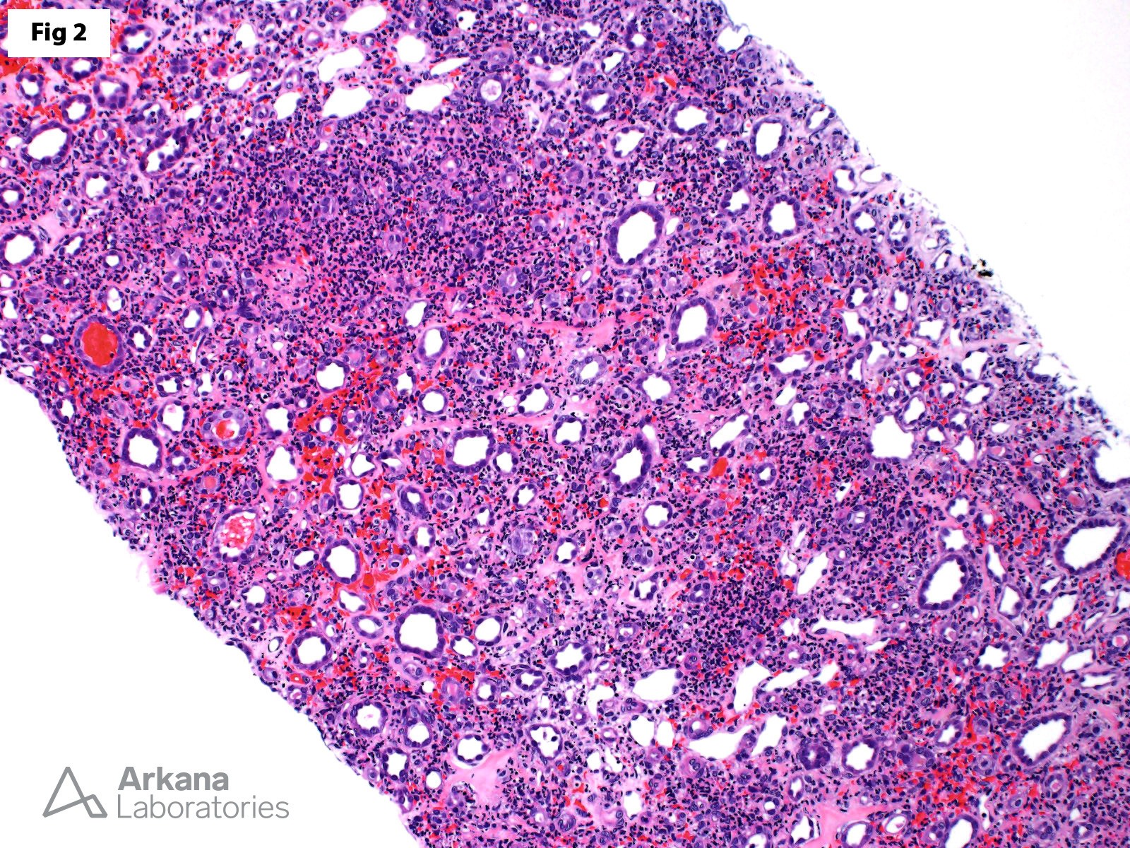 significant neutrophil-rich medullary angiitis