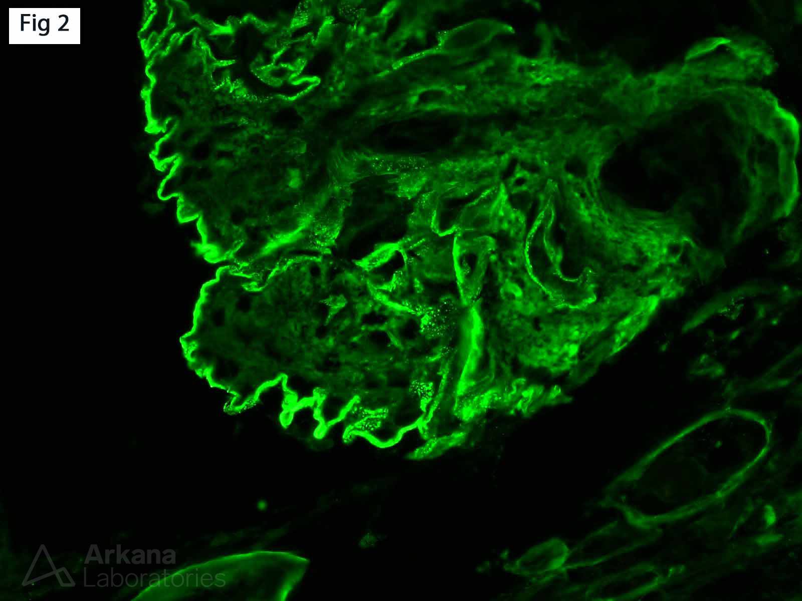 Diabetic Glomerulosclerosis