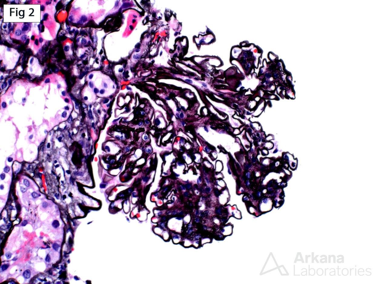 nodular mesangial matrix expansion, Smoking-Related Glomerulopathy