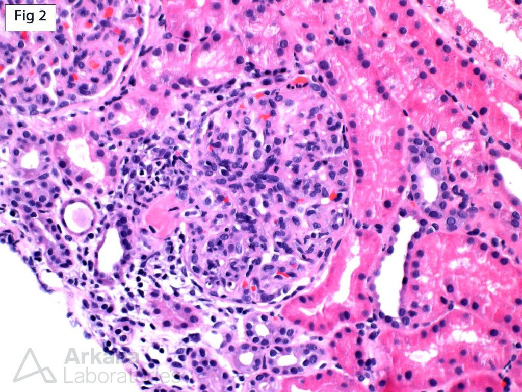 Thrombotic Microangiopathy, endothelial swelling, mesangiolysis